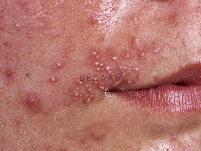 kem nhiễm corticoid